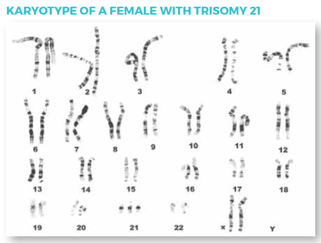 Karotype of a Female with Trisomy 21.